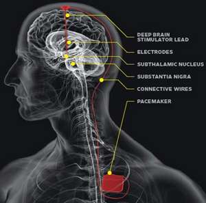 Чипы-импланты будут использоваться и пропагандироваться для медицинских целей. Однако контролировать подобные программы будут контролировать истинные заказчики - сатанисты. Постепенно шаг за шагом технология будет становиться более совершенной и приведёт к установлению не только контроля, но и влияния. Чипы-импланты будут …